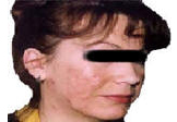 Acne on face after UVA phototherapy treatment.
