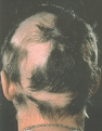 Picture of Alopecia Areata hair loss