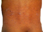 Dermatitis on body.