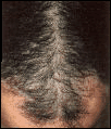 Hair loss on temple of head