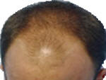 Hair loss before laser therapy.