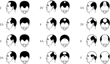 Male pattern hair loss or Androgenetic Alopecia