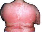 severe plaque psoriasis on back