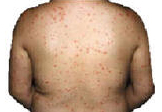 Psoriasis on back.