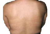 Psoriasis on back after UVB phototherapy.