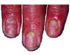 Psoriasis on fingers.