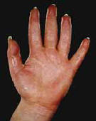 Hyperhidrosis sweating of the hands.