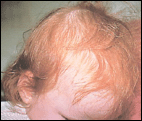 Picture of Telogen Effluvium hair loss