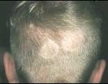 Picture of Tinea Capitis hair loss