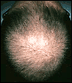 Hair loss on crown of head