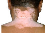 Vitiligo on back.