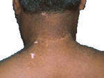 Vitiligo after UVB narrow band 311 phototherapy.