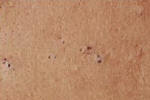 Picture of acne black head pimple.