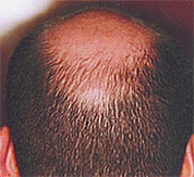 Hair loss after treatmet with Sunetics laser hair brush.