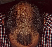 Hair loss before laser brush therapy.