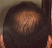 Hair loss before laser brush therapy.