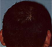 Hair loss after treatmet with Sunetics laser hair brush.