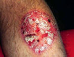 Circular psoriasis