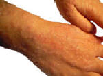 Dermatitis on hands