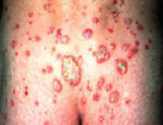 plaque psoriasis