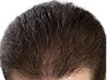 Hair loss after laser therapy.