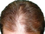 Hair loss before laser therapy.