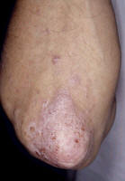 Plaque psoriasis on elbow.