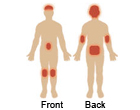 Areas affected by psoriasis.