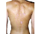 Psoriasis on back.