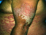 psoriasis body