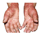 Psoriasis on hands.