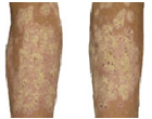 Psoriasis on legs.