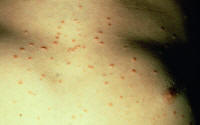 Guttate psoriasis.