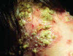 pustule psoriasis