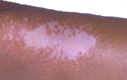 Vitiligo on arm