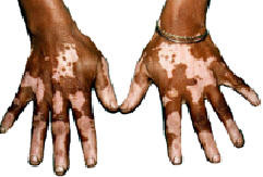 Vitiligo on hands